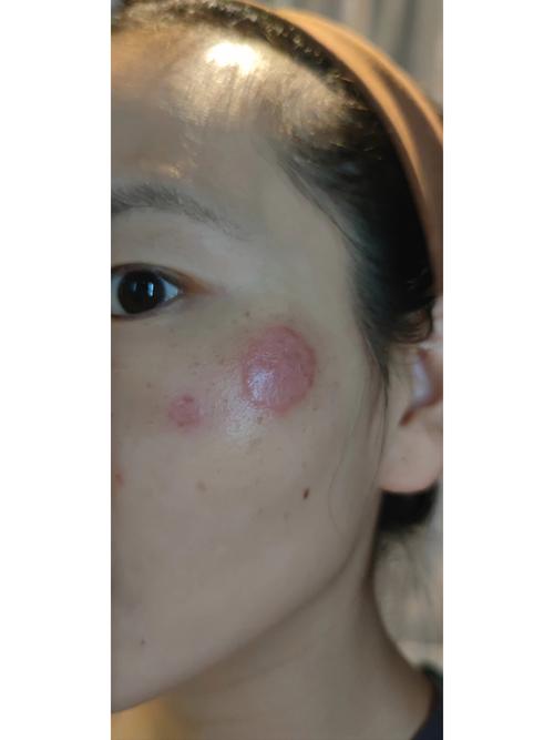 脸上长癣的图片和症状图