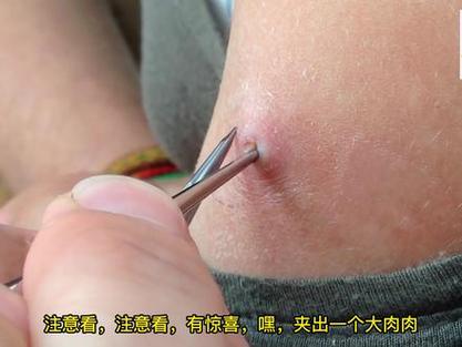 人身上长蛆虫的视频