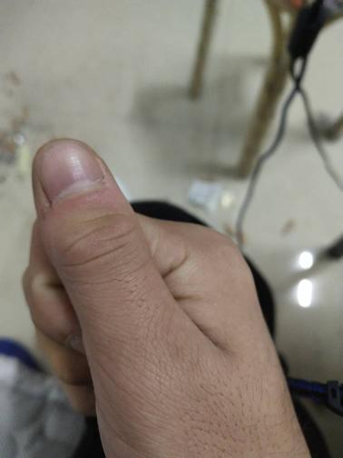大拇指无端端肿了