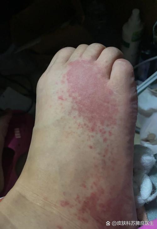 身上红点变黑点正常吗