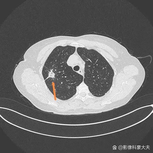 单排ct和多排ct的区别