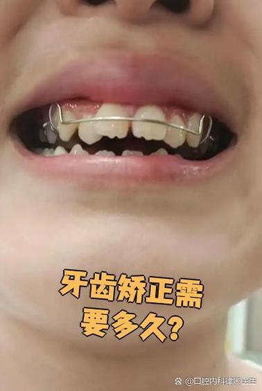 儿童牙齿上下咬合对齐怎么矫正