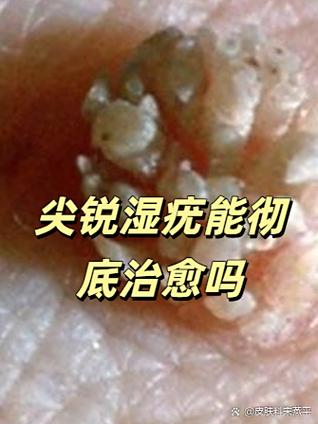 清除尖锐疣病毒最好的方法