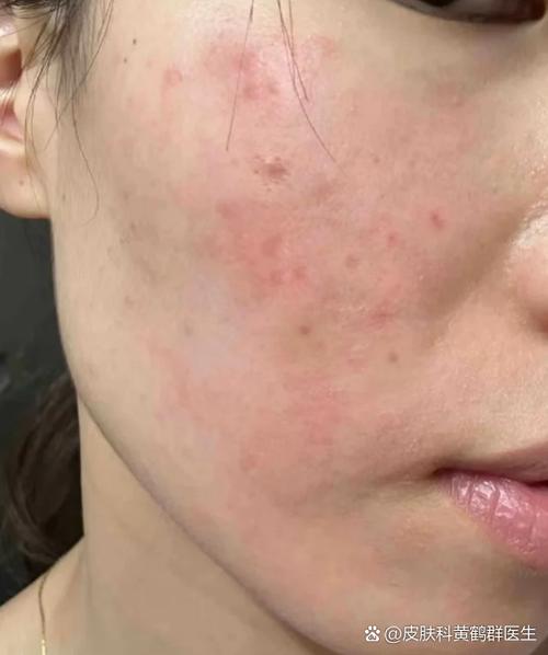 一吃辣脸上就长痘怎么治