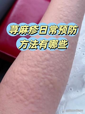 40岁突然荨麻疹要警惕