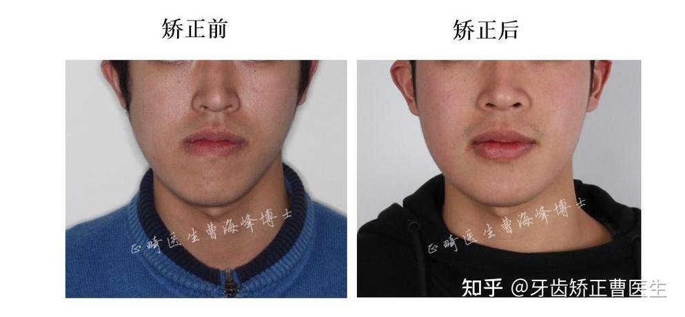 下颌骨错位怎么矫正