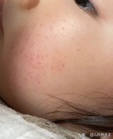 面部起红点什么原因导致的