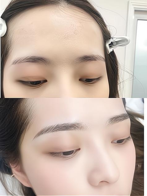 眉弓填充前后对比照片