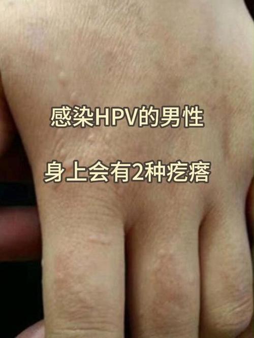 男性hpv有什么症状