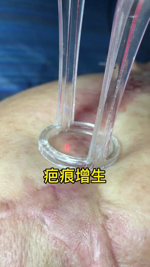 十几年的疤痕能去除吗