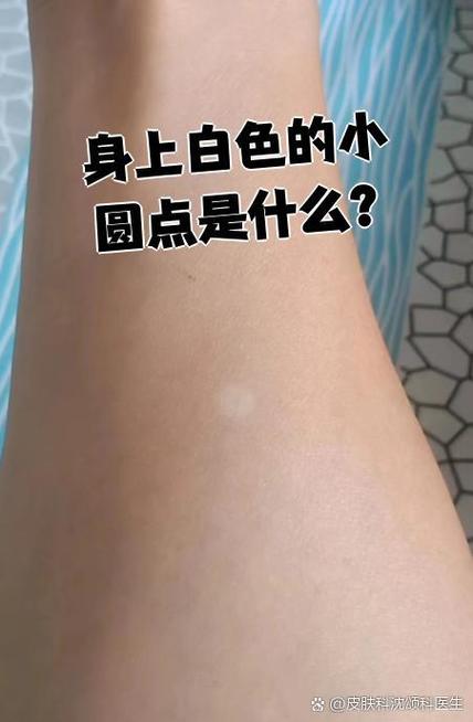 身上小白点怎么消除
