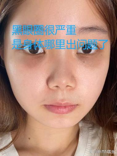 眼睛周围有黑眼圈