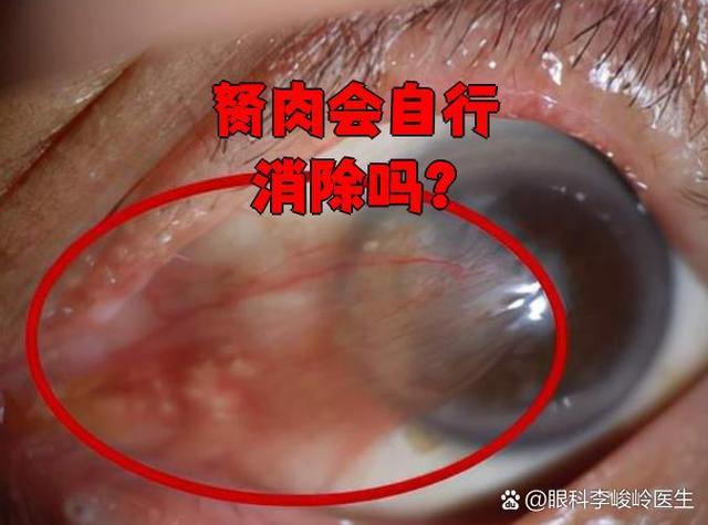 眼睛胬肉严重吗截图3