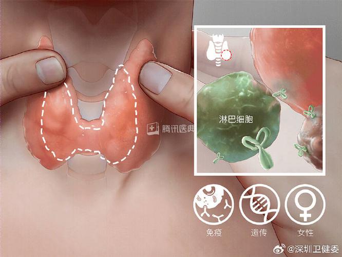 什么叫桥本氏甲状腺