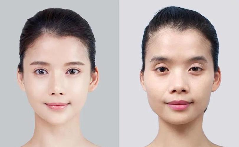 脸凹陷了怎么恢复正常