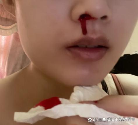 流鼻血是肺热的表现吗