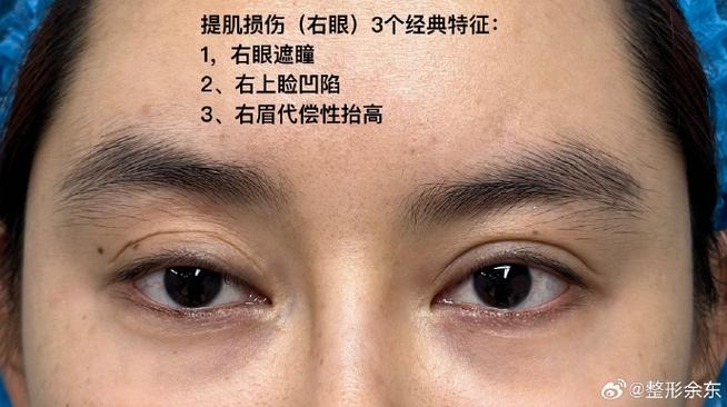双眼皮一旦提肌就很难看吗