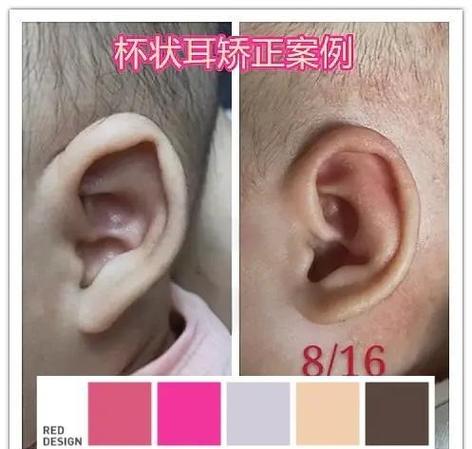 宝宝耳朵矫正最佳时间