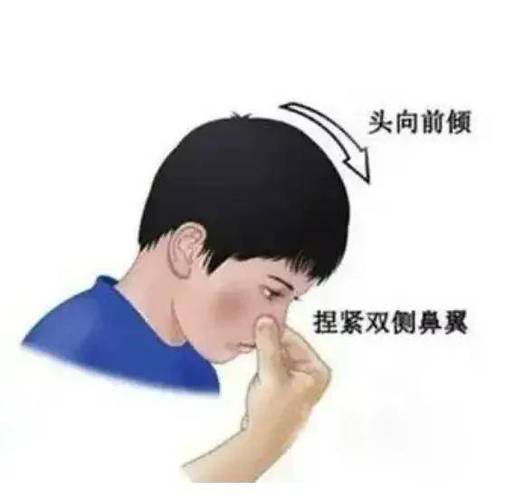 流鼻血怎么弄