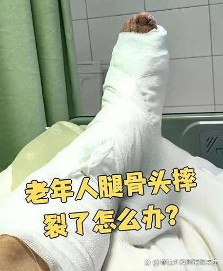 腿上骨头摔碎了