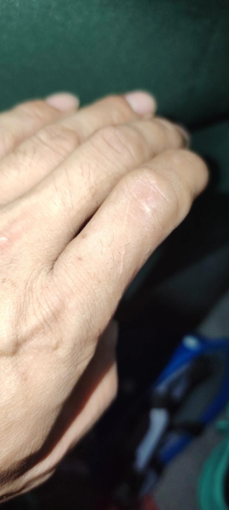 手指有白色疤痕状条纹