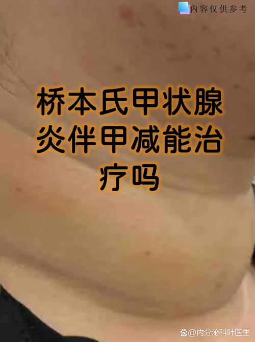 乔本甲状腺炎甲减能治好吗