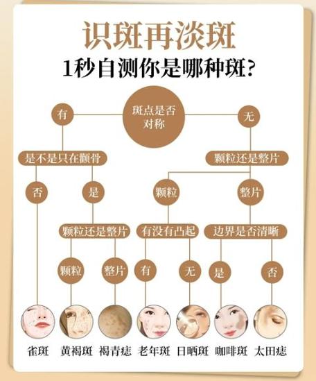雀斑怎么去除
