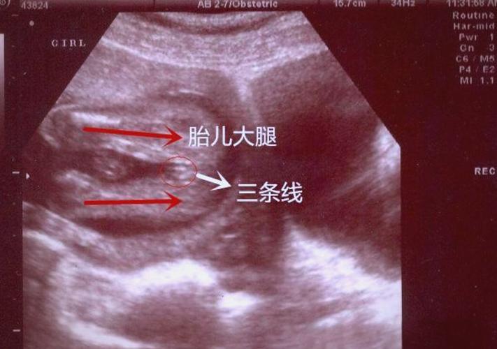 孕期怎样辨别男孩女孩