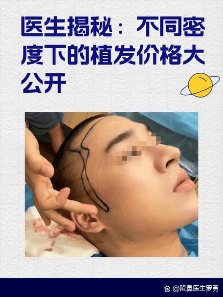 为什么医生不建议植发