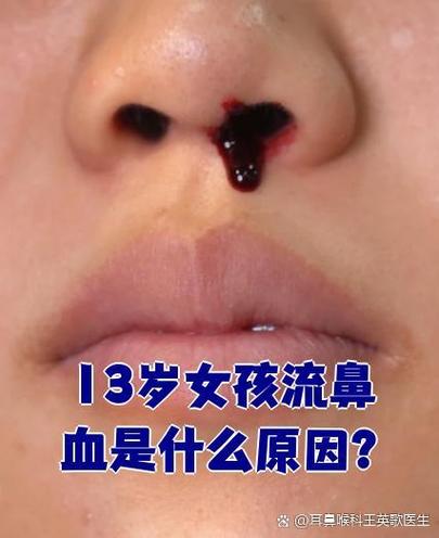 激光烧鼻子还会流鼻血吗