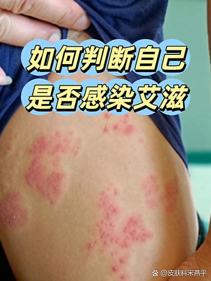 艾滋病毒会在衣服上吗