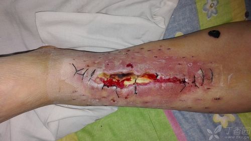 胫腓骨远端骨折后遗症