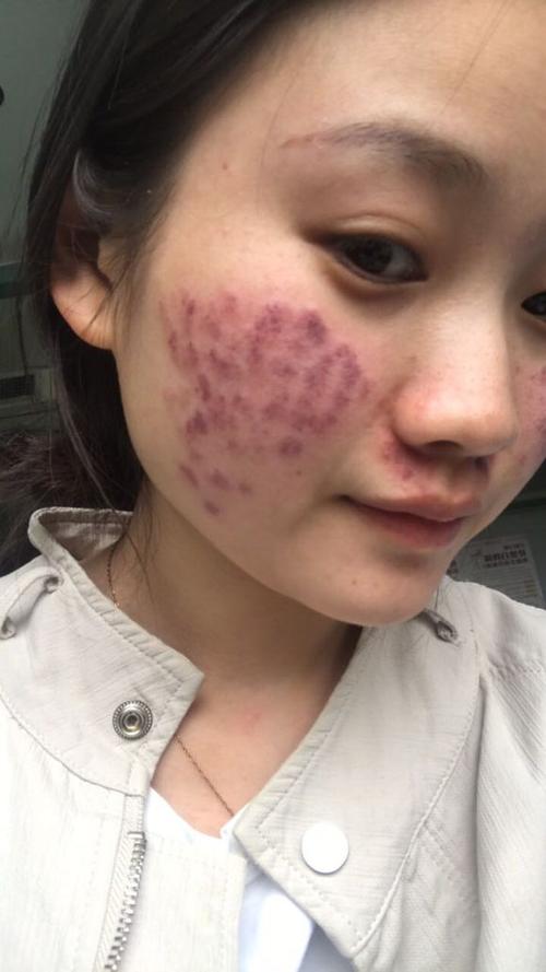 去红血丝第一名