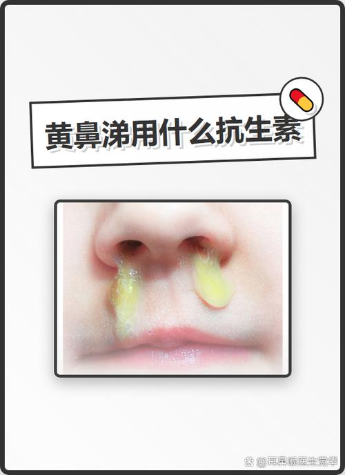 流黄鼻涕偏方