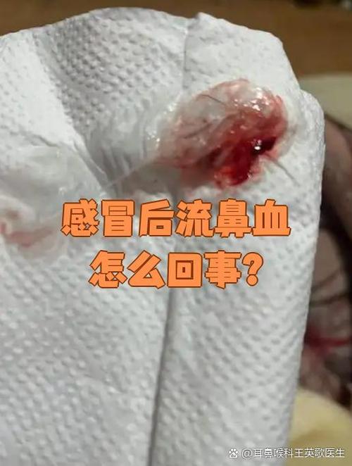 我什么会流鼻血