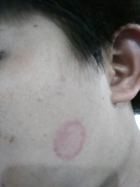 脸上长了一个圆圈的癣