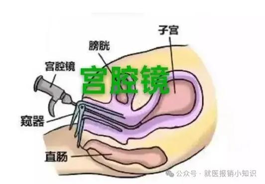 宫腔镜和腹腔镜手术一样吗