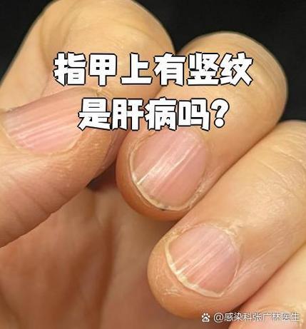 指甲有竖纹和肝有关系吗