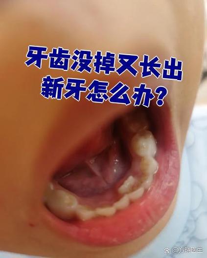 儿童旧牙齿在摇却长出新芽