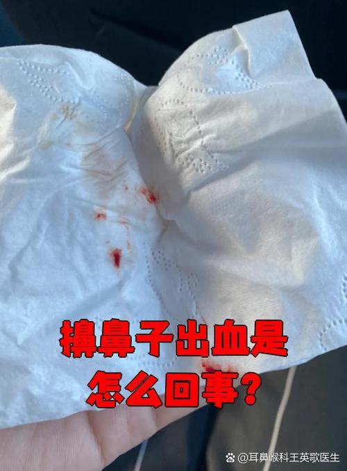 老是擤鼻涕擤出鼻血