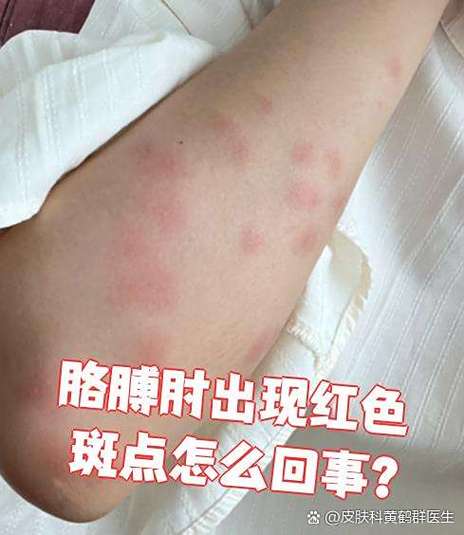 过敏性皮炎红斑图片