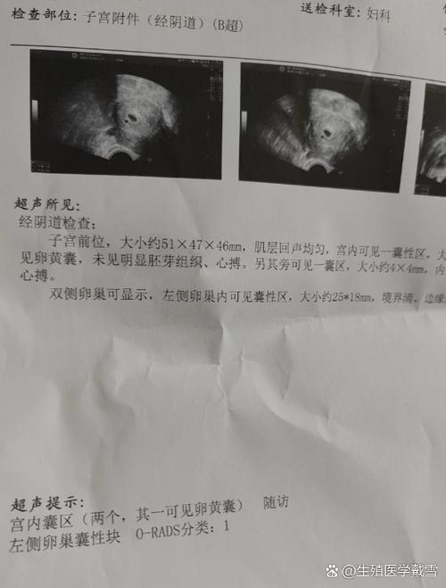 早孕宫内可见一液性暗区