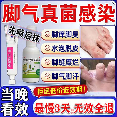 脚气烂脚趾缝痒溃烂怎样治疗