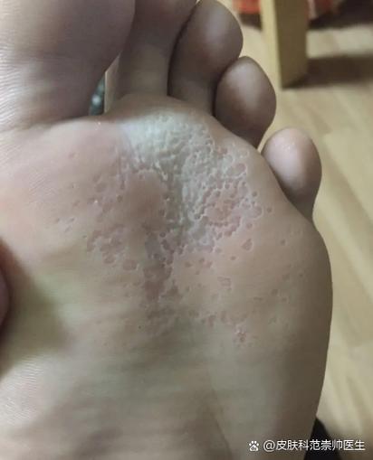 脚气痒是真菌在咬吗