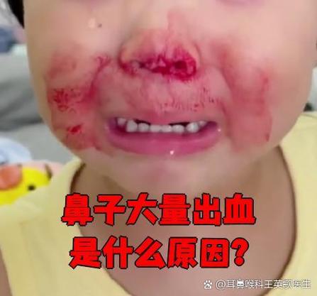 为什么俩鼻子都光流鼻血