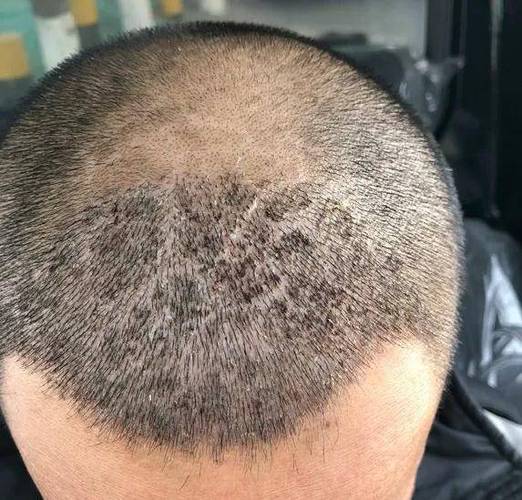 什么季节植发效果最好