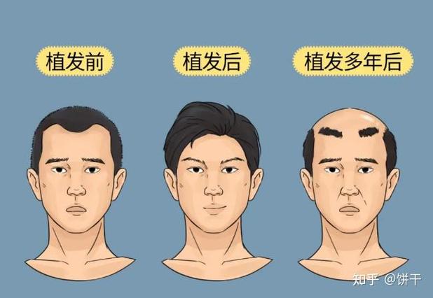 植发一般能维持几年