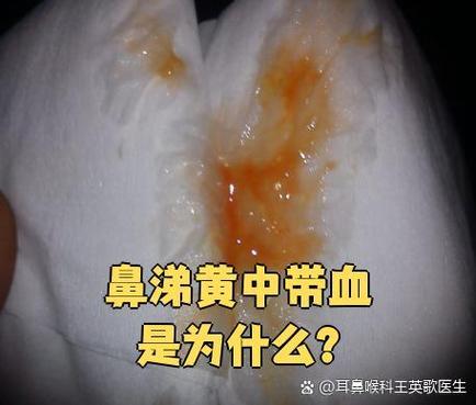 鼻子黄鼻涕到吸有一点血丝