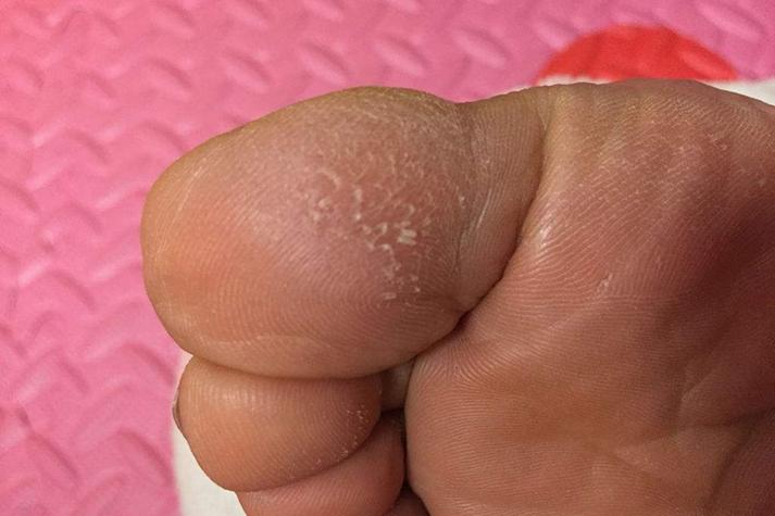 脚底有倒刺用什么方法治疗