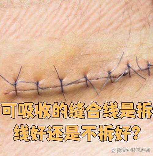 美容线不拆线可以吗